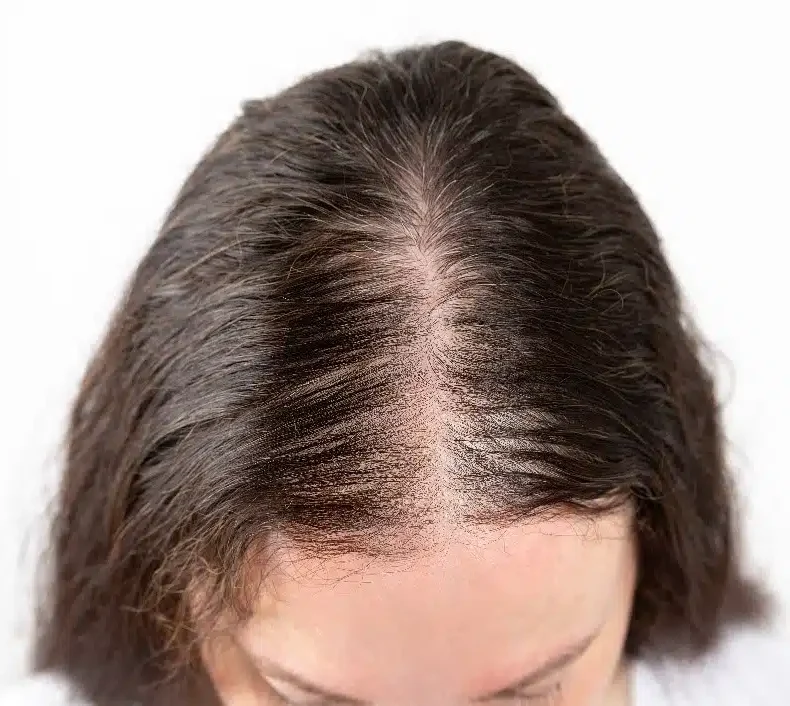 Read more about the article My Hair Loss Journey as a Young Woman: proven 5 solution