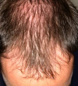 Read more about the article Dealing With Hair Loss Anxiety: 6 Tips for Mental Health